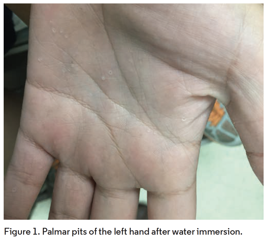 What Syndrome Caused These Palmar Pits?